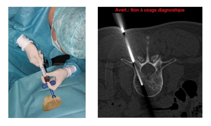 biopsy biopsy